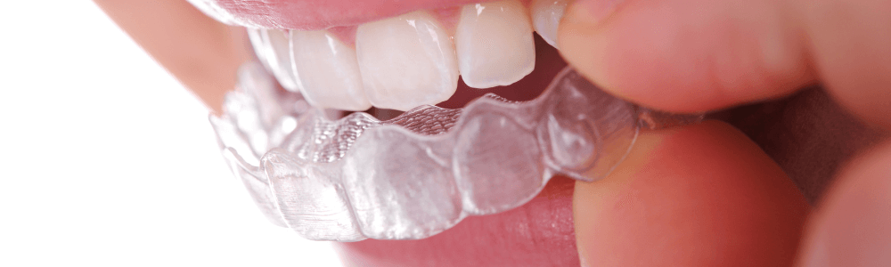 woman putting in Invisalign braces in Maidstone, Kent